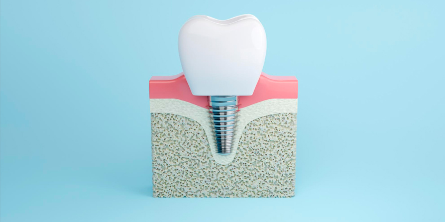 Implante unitario, una solución efectiva para recuperar tu sonrisa.