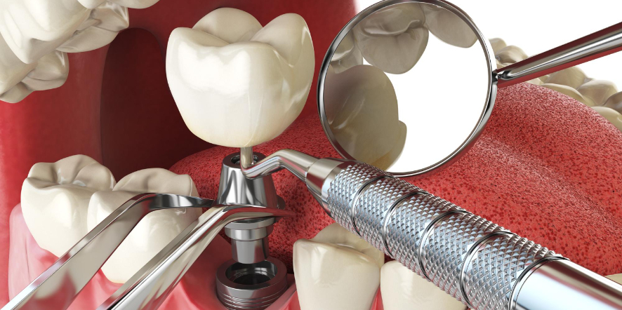 Implantes dentales fijos o removibles. ¿Cuál es la mejor elección para ti?