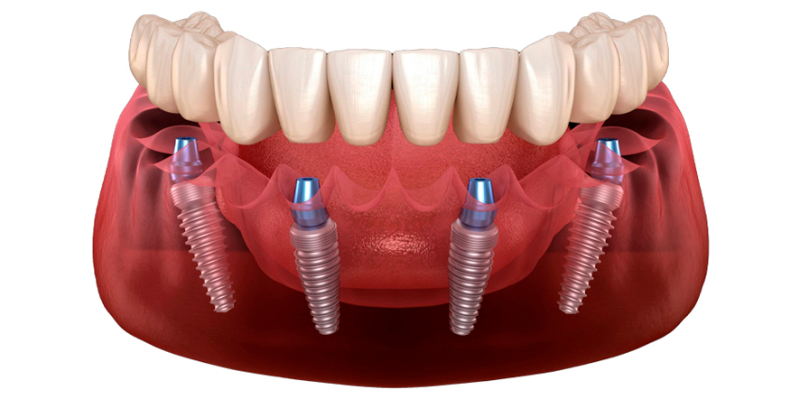 Prótesis fija sobre implantes, una solución dental efectiva y de calidad.
