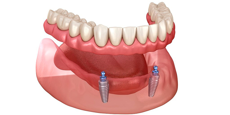 Sobredentadura con locator: Descubre todo lo que necesitas saber sobre este tratamiento dental.